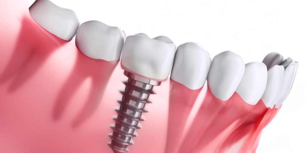 Dental Implants