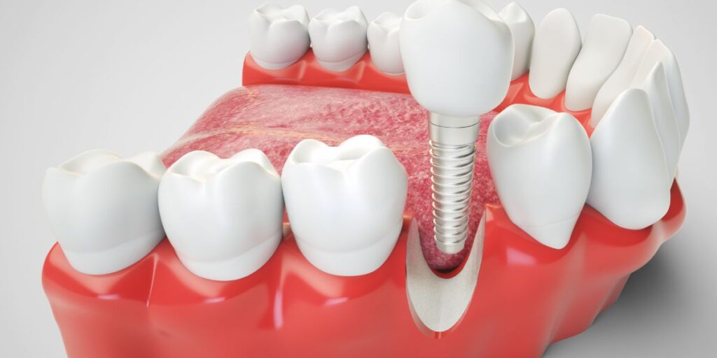 The Science Behind Dental Implants